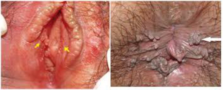 Genital Siğil Tedavisi Ankara