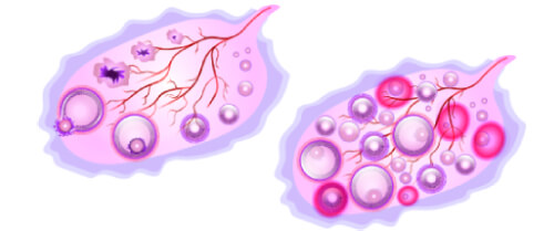 Miyom Tedavisi Ankara