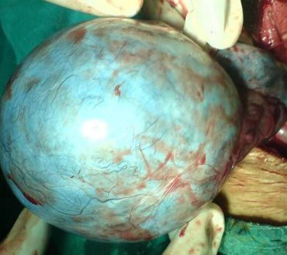 Yumurtalık Kistleri